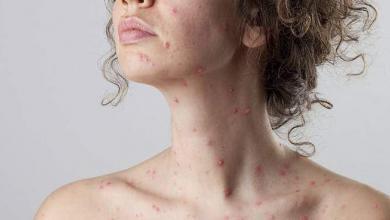 Photo of Morbillo, sintomi e cura