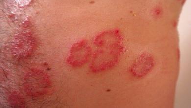 Photo of Dermatite: sintomi e tipologie più comuni