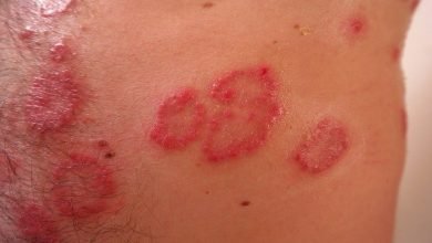 Photo of Dermatite allergica da contatto: cause, sintomi e complicazioni